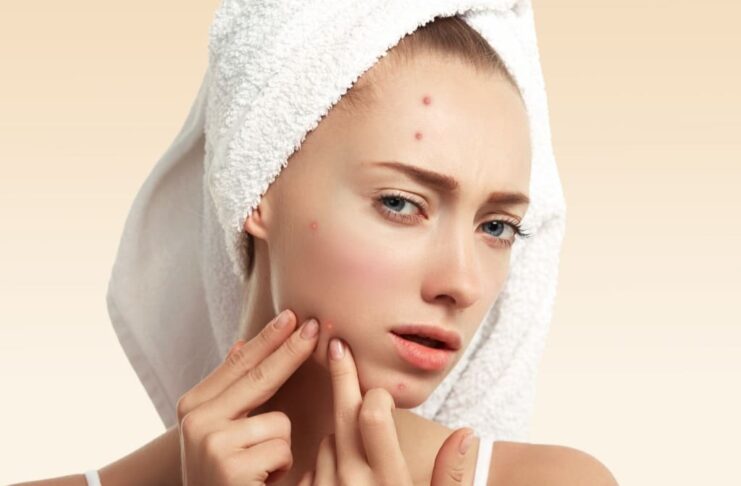 acne-pre-menstrual